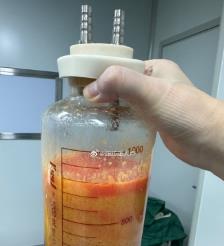 昭通水动力吸脂手术要做多久？
